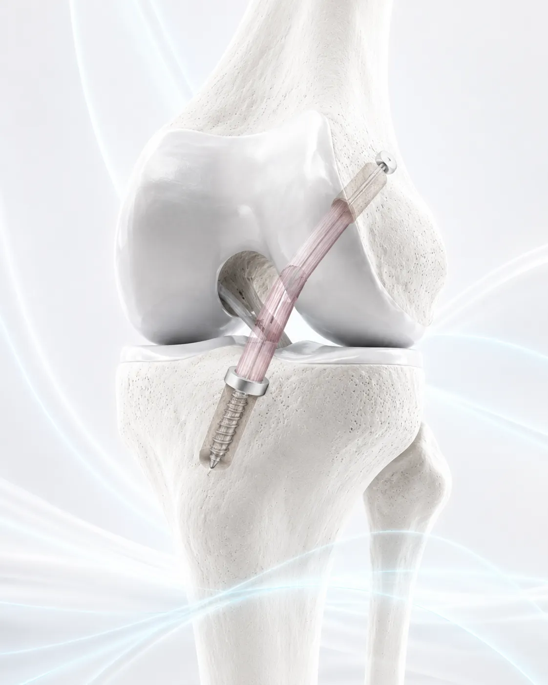 An anterior cruciate ligament graft fixed in the knee with an interference screw